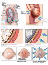 Brain Injuries Due to Contractions