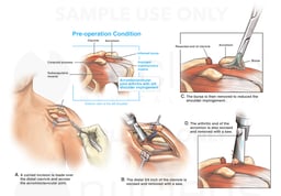 Acromioclavicular Joint Arthritis and Treatment with Surgical Repairs
