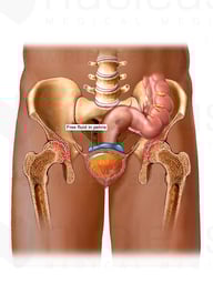 Bilateral Hip Spurring