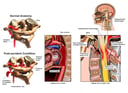 C1-C2 Fracture Dislocation with Spinal Cord Injury and Aortic Rupture