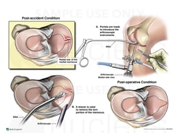 Right Medial Radial Meniscal Tear with Arthroscopic Repair