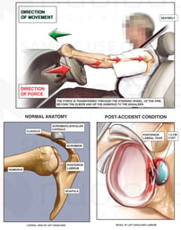 Mechanism of Shoulder Injury in Motor Vehicle Accident (MVA)