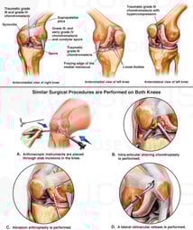 Bilateral Knee Injuries with Arthroscopic Surgeries