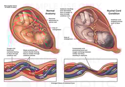 Fetal Nuchal Cord and Subsequent Asphyxia