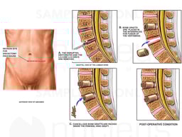L4-5 and L5-S1 Discectomies and Fusion Procedures