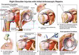 Rotator Cuff Repair