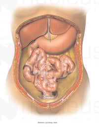 Female Torso with Final Condition after Abdominal Surgeries