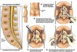Lumbar Disc Injury with Subsequent Surgical Discectomy