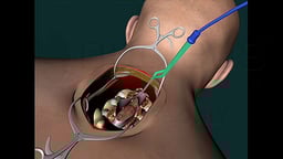 Cervical Cavernous Angioma with Pre-existing Cardiac Complications