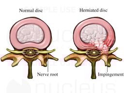 Spinal Nerve Root Impingement