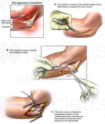Right Ulnar Nerve Injury with Surgical Transposition