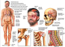 Male Figure with Facial-Scalp Injuries, Brain INjury, and Fractures to the Hip, Shoulder and Neck