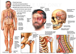 Male Figure with Facial-Scalp Injuries, Brain INjury, and Fractures to the Hip, Shoulder and Neck