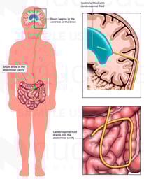 The Function of a Ventriculoperitoneal Shunt
