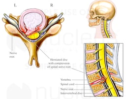Cervical Disc Herniation with Spinal Cord Impingement