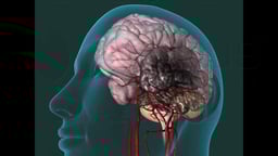 Progression of carotid artery occlusion and resulting cerebral infarct (stroke)
