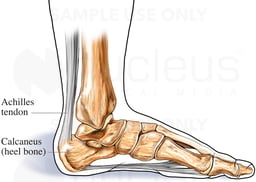 Achilles Tendon