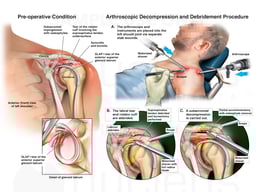 Left Shoulder Injuries with Surgical Repairs