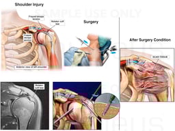 Left Shoulder Injuries and Surgical Repairs