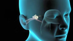 Myringotomy (Ear tubes)