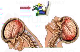 Closed Head Traumatic Brain Injury (TBI) - Coup and Contrecoup