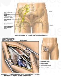 Post-operative Condition with Inguinal Nerve Entrapment