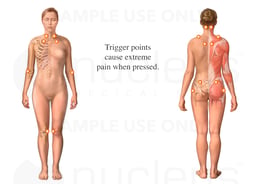 Fibromyalgia Syndrome: Tender Points, female