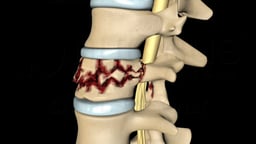 Indications for Spinal Fusion