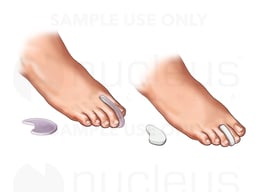 Foot Pads for Corns