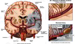 Left Middle Cerebral Artery Blockage