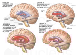 Classification of Brain Hemorrhage