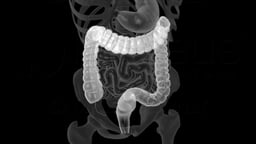 3D Radiographic View of the Large Intestine with Focus on the Transverse Colon