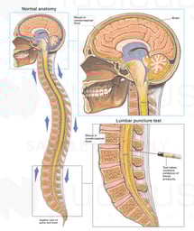 Testing for Cerebral Aneurysm