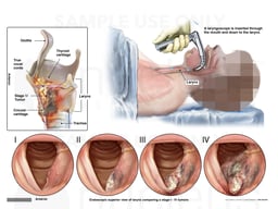 Progression of Laryngeal Cancer