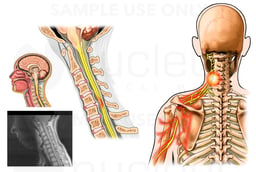 Cervical Spine Injury