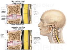 Whiplash Injury - Anterior Cervical Rim Lesion