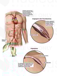 Additional Surgical Procedures to Repair Subclavian Artery Clot