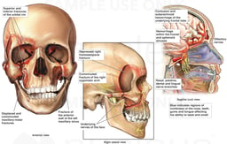 Facial Fractures resulting in Brain Damage