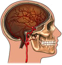Skull with Arteries of the Brain and Berry aneurysm, Lateral View