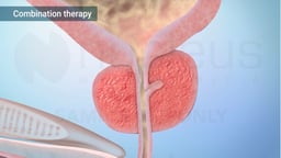 Medications for Benign Prostatic Hyperplasia (BPH)