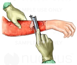 Severe Burn Debridement