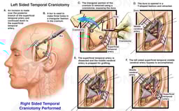 Surgical Craniotomy with Temporal to Middle Cerebral Artery Bypass