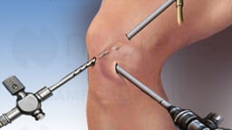 Knee Arthroscopy
