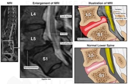 Lumbar Spine Injury