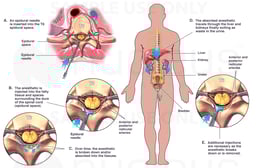 Injection and Breakdown of Epidural Anesthesia