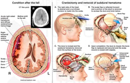 Head Injury with Emergency Brain Surgery