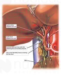 Post-operative Cholecystectomy with Bile Leakage