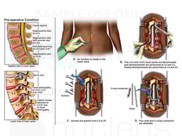 Lumbar Spine Injuries with Multilevel Surgical Decompression and Fusion Procedure
