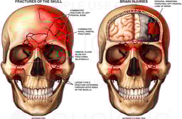 Post-accident Head and Brain Injuries