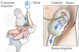 Colostomy Irrigation